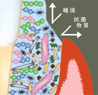 むし歯になりやすい条件がそろってしまった場合にお勧めするのが、3DS(Dental Drug Delivery System)というむし歯予防法